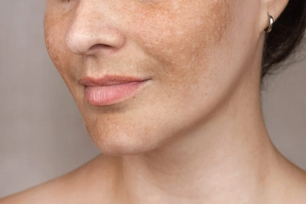 Brown Spot regenerative aesthetics and dermatology laguna hills ca