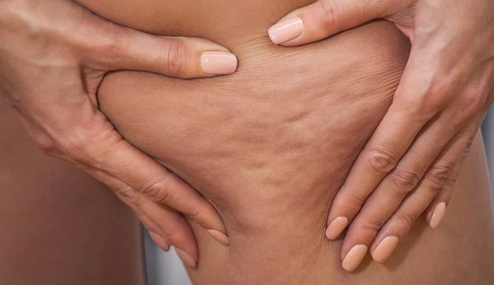 Cellulite Dimple Release regenerative aesthetics and dermatology laguna hills ca