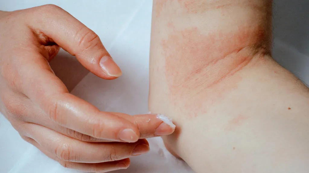 Eczema regenerative aesthetics and dermatology laguna hills ca