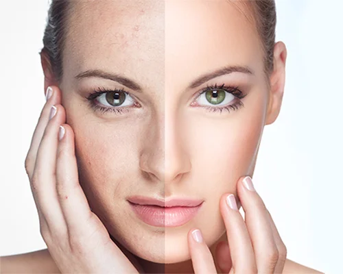 IPL-Photorejuvenations-regenerative-aesthetics-and-dermatology-laguna-hills-ca