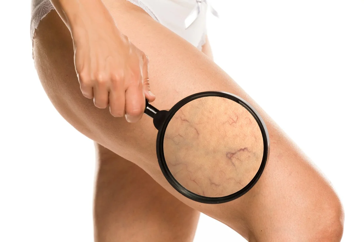 Leg-Vein-Reduction-regenerative-aesthetics-and-dermatology-laguna-hills-ca