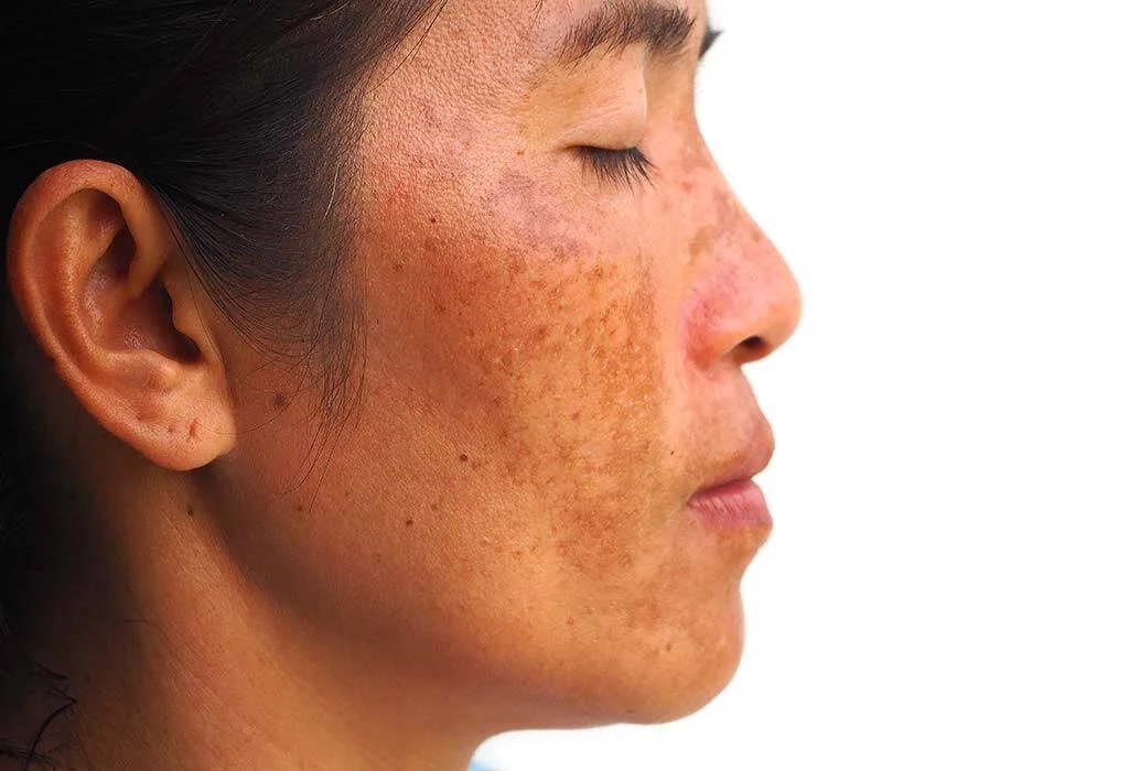 Melasma-regenerative-aesthetics-and-dermatology-laguna-hills-ca
