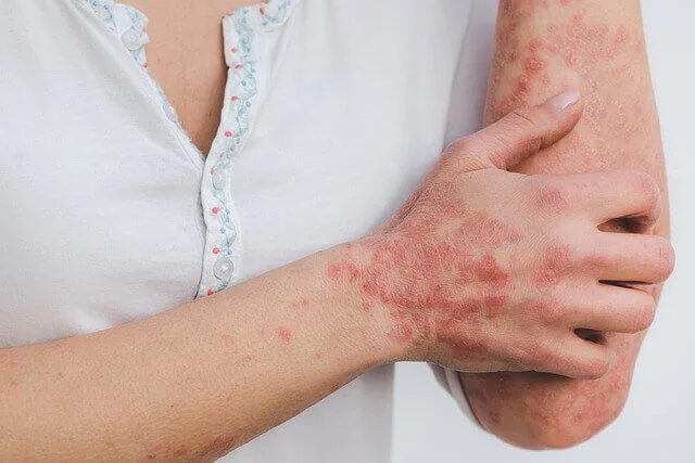 Psoriasis-regenerative-aesthetics-and-dermatology-laguna-hills-ca