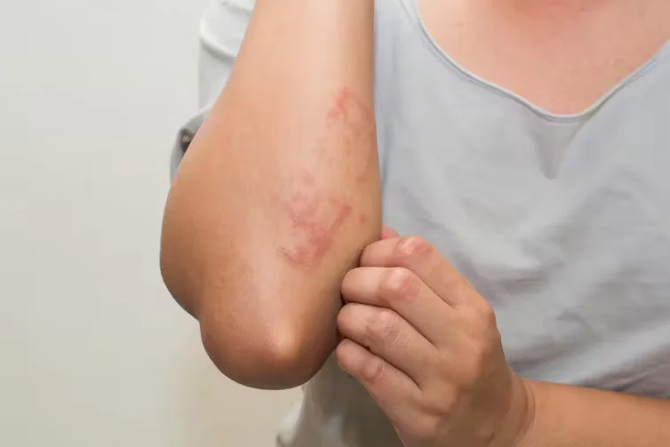 Rashes-regenerative-aesthetics-and-dermatology-laguna-hills-ca