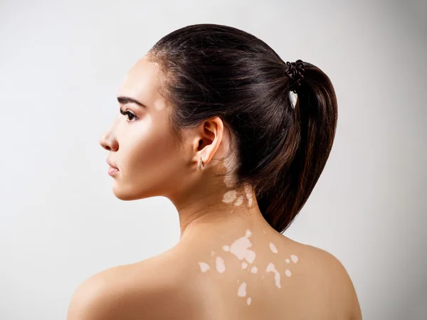 Vitiligo-regenerative-aesthetics-and-dermatology-laguna-hills-ca
