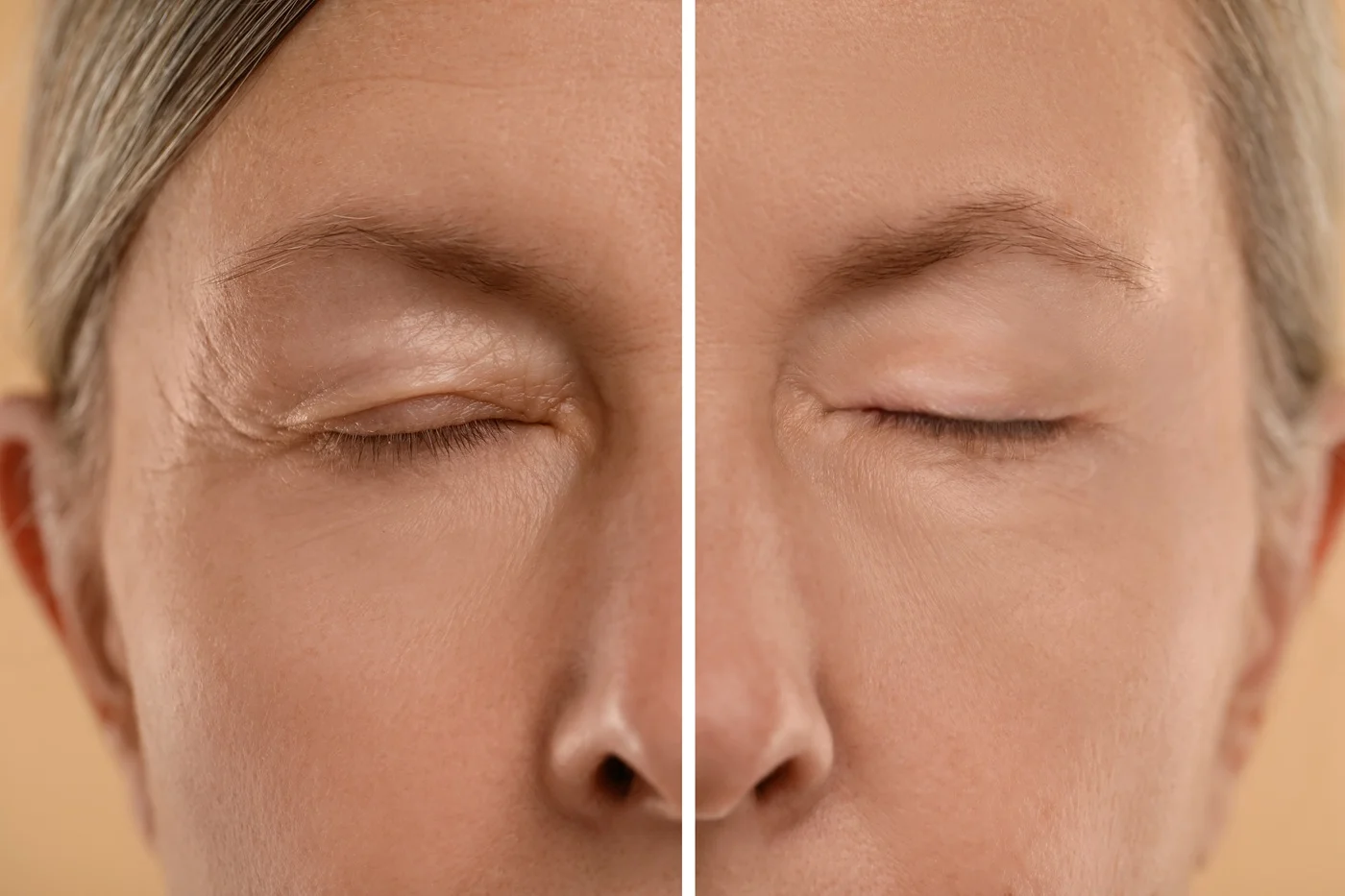 blephroplasty regenerative aesthetics and dermatology rad laguna hills ca